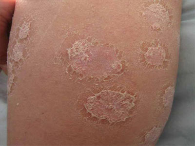 牛皮癣的症状是什么