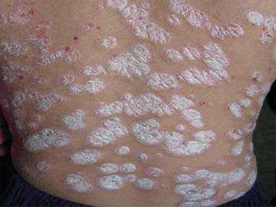 怎么避免牛皮癣加重